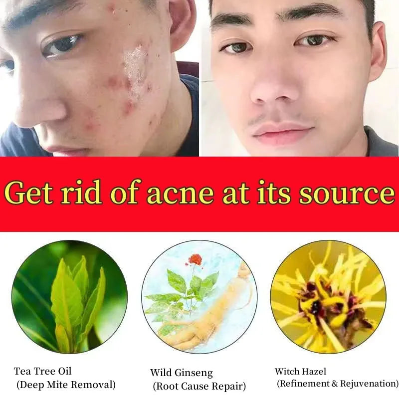 Sheromom's Salicylic Acid Acne Cream Shrink Pores Blackheads Scars Acne Marks Blemishes Oil Control Whitening Korean Skin Care Products
