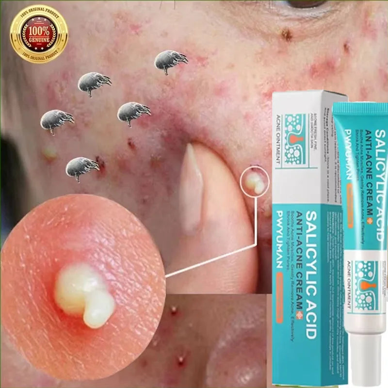 Sheromom's Salicylic Acid Acne Cream Shrink Pores Blackheads Scars Acne Marks Blemishes Oil Control Whitening Korean Skin Care Products