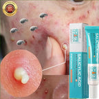 Sheromom's Salicylic Acid Acne Cream Shrink Pores Blackheads Scars Acne Marks Blemishes Oil Control Whitening Korean Skin Care Products