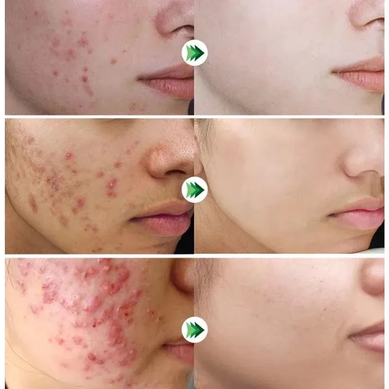 Sheromom's Salicylic Acid Acne Cream Shrink Pores Blackheads Scars Acne Marks Blemishes Oil Control Whitening Korean Skin Care Products