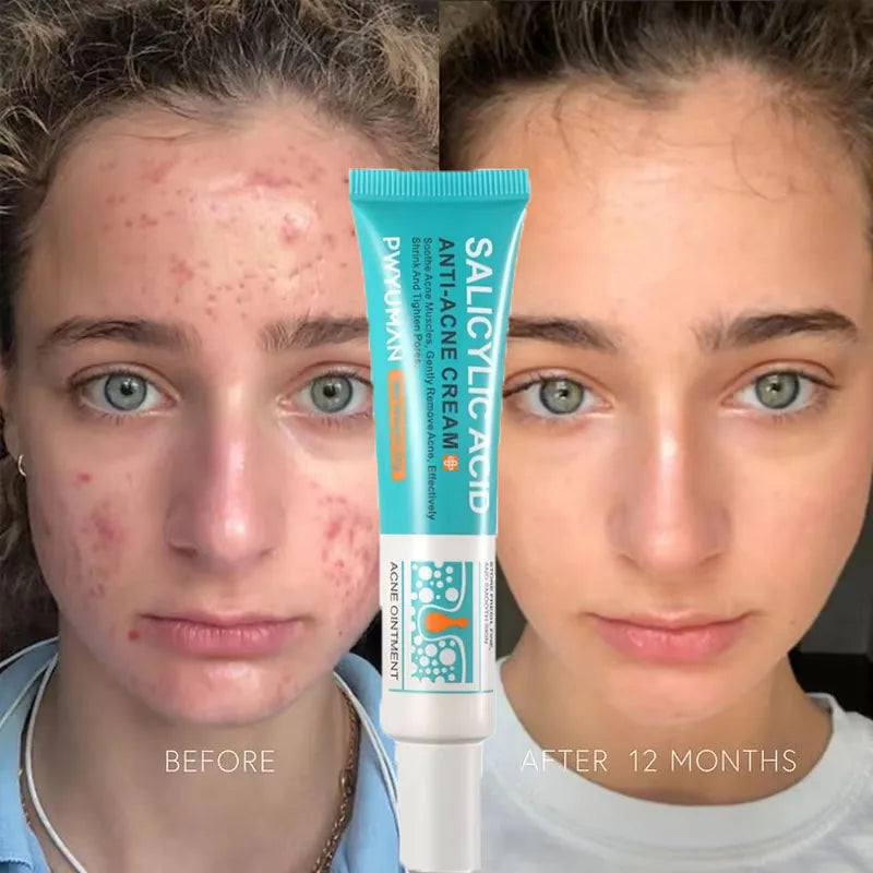 Sheromom's Salicylic Acid Acne Cream Shrink Pores Blackheads Scars Acne Marks Blemishes Oil Control Whitening Korean Skin Care Products